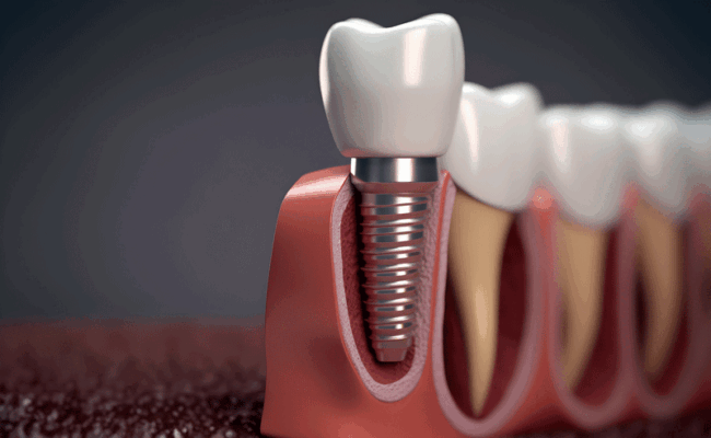 imp2 Medically accurate 3D illustration of human teeth and Implant concept