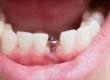 close up shot of a patient’s mouth with a single implant
