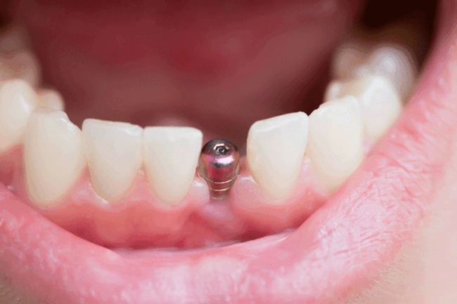 11-23-Impant-2 close up shot of a patient’s mouth with a single implant