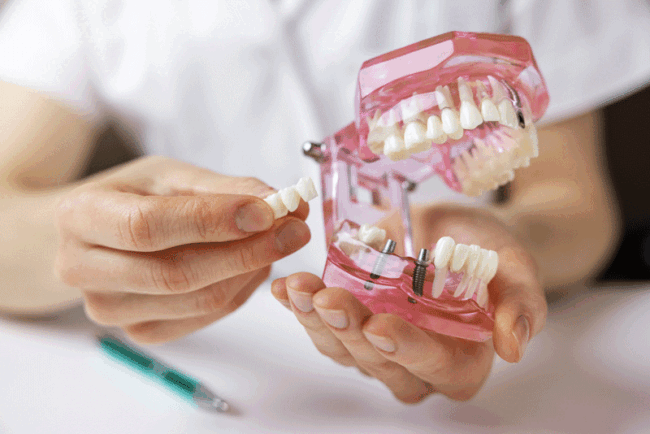 11-23-Implants-1 dentist implantologist showing dental bridge implant technology on human tooth jaw model