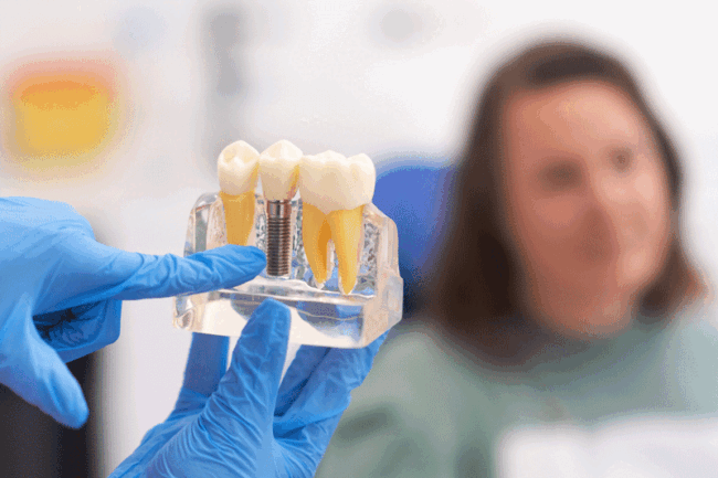 dentalimplants2-12-23 Close-up of dental model with implant. patient of dental clinic on blurred background. dentistry