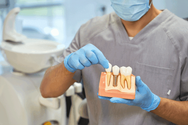 Implants1-24 A dental doctor with a model of a dental implant in his hands