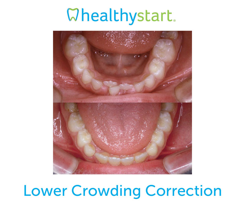 Correction of Lower Mouth Crowding