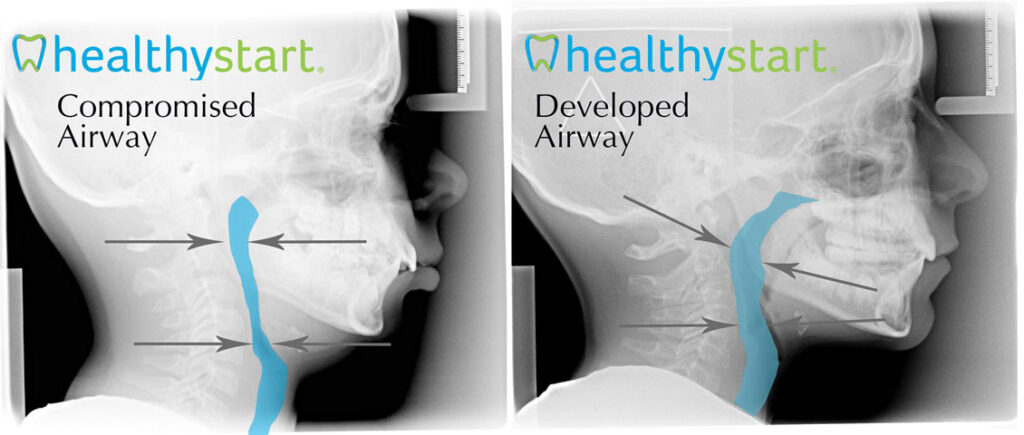 Compromised Vs. Developed Airway