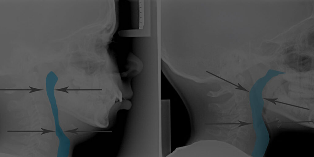 Xray - Compromised Vs. Developed Airway