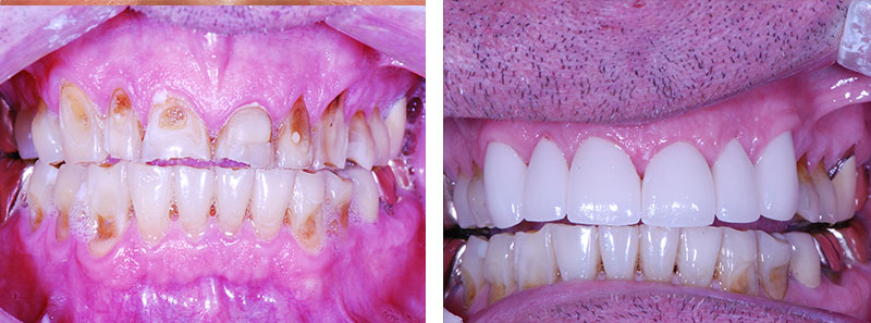 Dental Smile Gallery Bradburn Village Dentistry Westminster CO Dental Smile Gallery Bradburn Village Dentistry Westminster CO